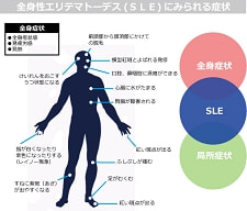 全身性エリテマトーデス(SLE)の症状図