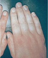 レイノー現象の写真