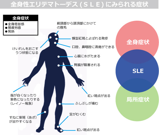 全身性エリテマトーデス(SLE)の症状図