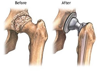 人工関節置換術