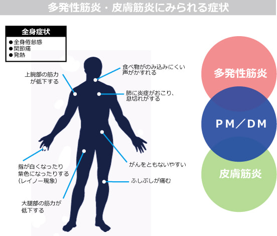 筋炎にみられる症状の図