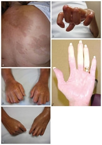 強皮症・皮膚硬化