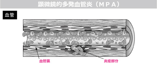 顕微鏡的多発血管炎図