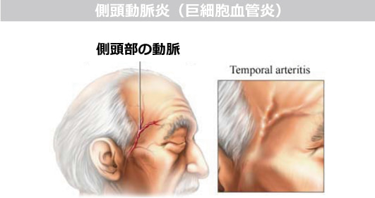 側頭動脈炎（巨細胞血管炎）