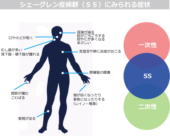 シェーグレン症候群（ＳＳ）にみられる症状